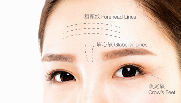 三大動態皺紋：皺眉時的眉心紋、抬眉時的額頭紋，大笑時的魚尾紋。